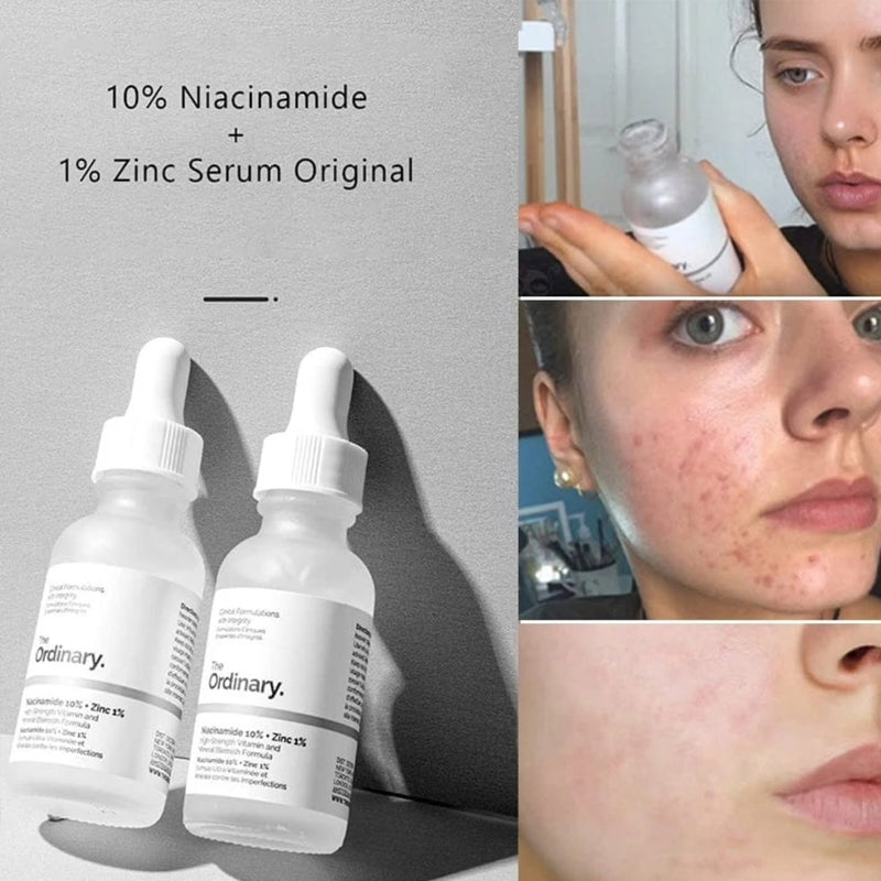 The Ordinary Niacinamide 10% + Zinc 1% – High-Strength Blemish & Pore Refining Serum