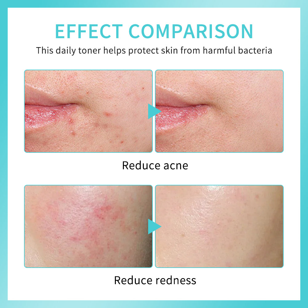 lakerain Daily Rescue Facial Spray – Hypochlorous Acid Soothing & Purifying Face Mist